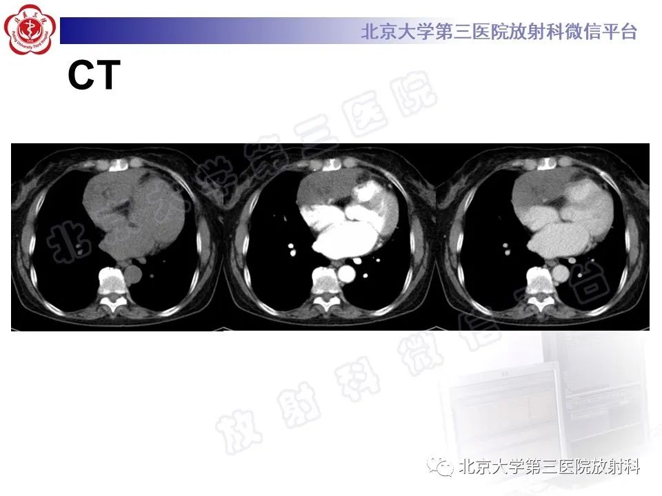 【PPT】心脏血管瘤-3