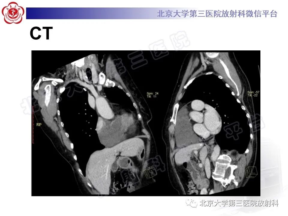 【PPT】心脏血管瘤-4