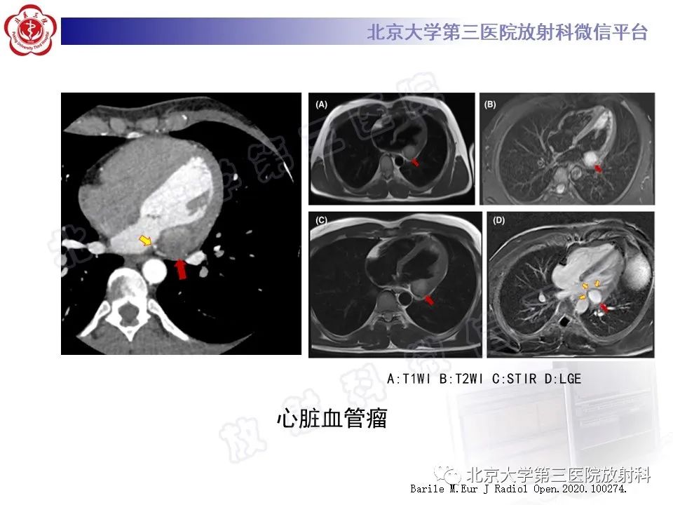 【PPT】心脏血管瘤-13