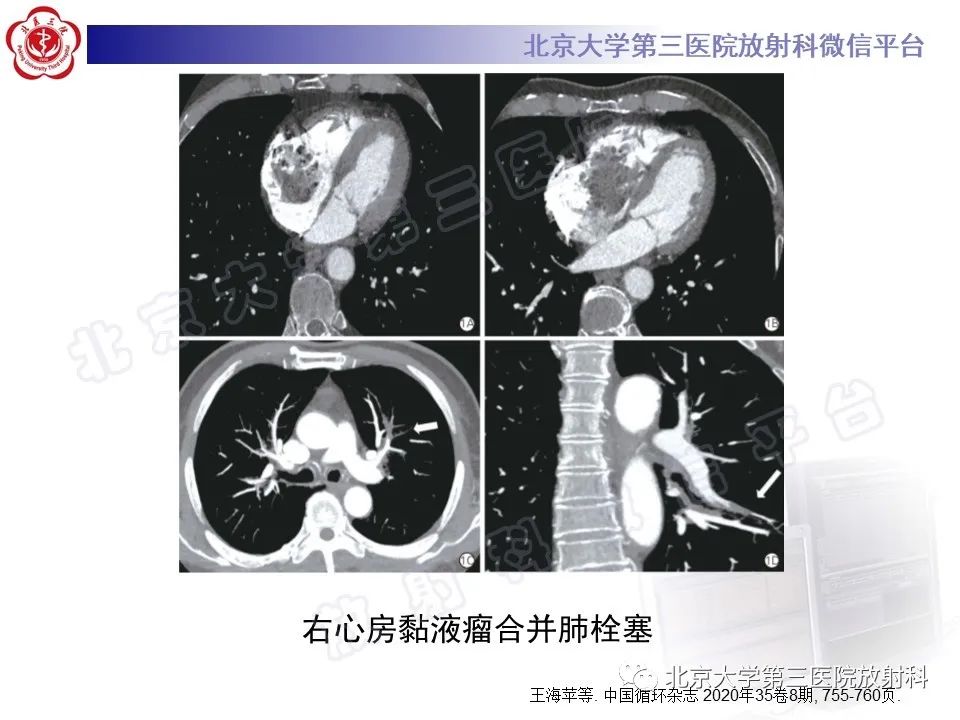 【PPT】心脏血管瘤-17