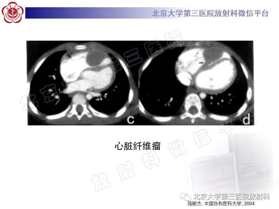 【PPT】心脏血管瘤-19