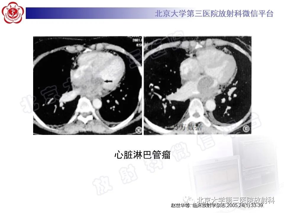 【PPT】心脏血管瘤-21