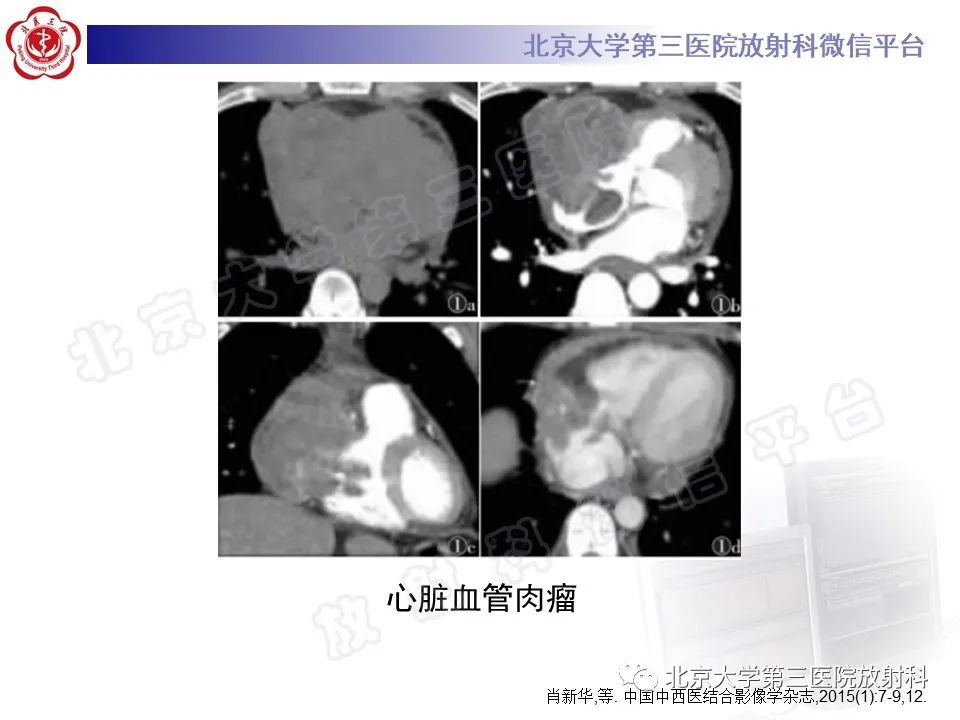 【PPT】心脏血管瘤-24