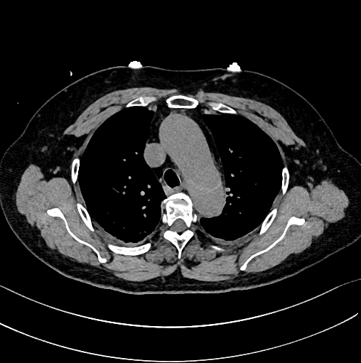 急性主动脉夹层的临床特征和影像学-4