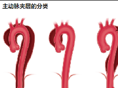<b>急性主动脉夹层的临床特征和影像学</b>