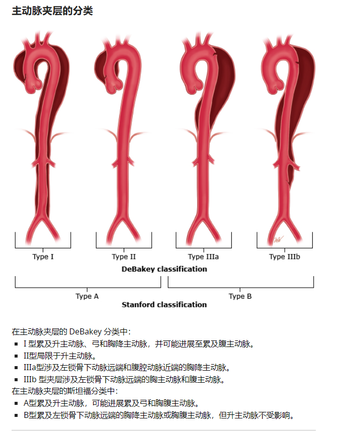 急性主动脉夹层的临床特征和影像学-1