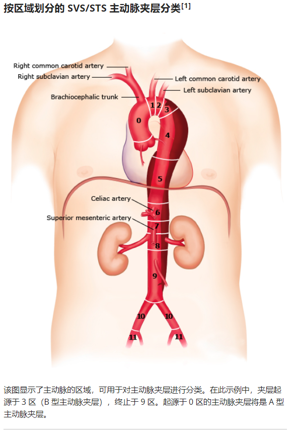 急性主动脉夹层的临床特征和影像学-2