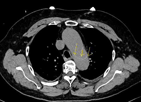 急性主动脉夹层的临床特征和影像学-5