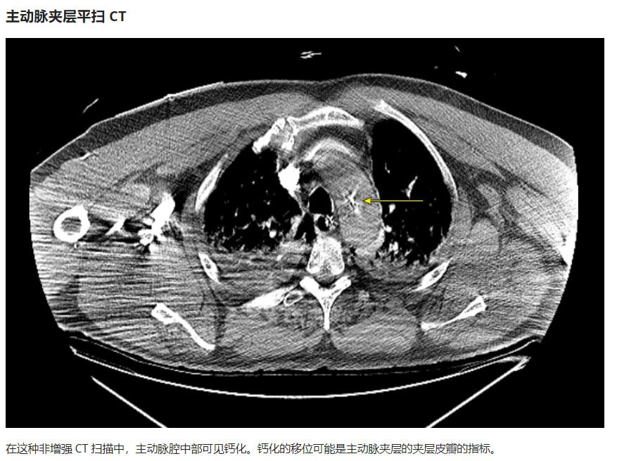 急性主动脉夹层的临床特征和影像学-3