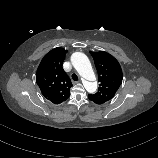 急性主动脉夹层的临床特征和影像学-6