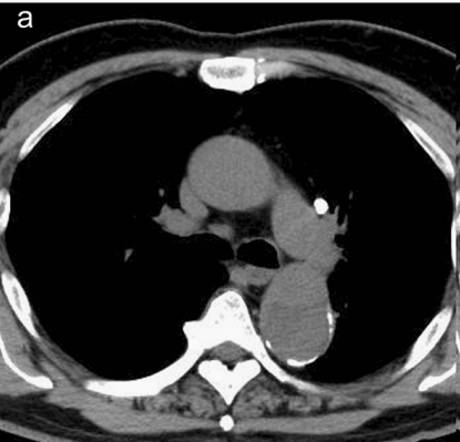 急性主动脉夹层的临床特征和影像学-7