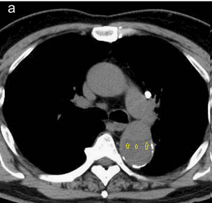 急性主动脉夹层的临床特征和影像学-8