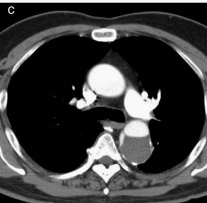 急性主动脉夹层的临床特征和影像学-9