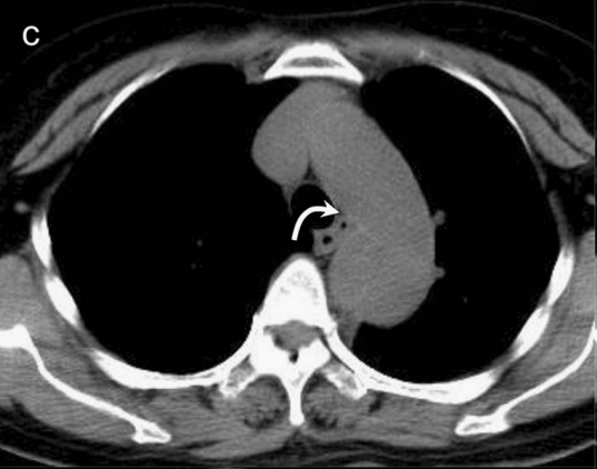 急性主动脉夹层的临床特征和影像学-10