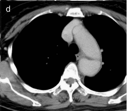 急性主动脉夹层的临床特征和影像学-11