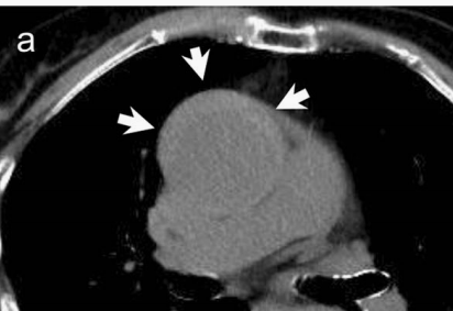 急性主动脉夹层的临床特征和影像学-12