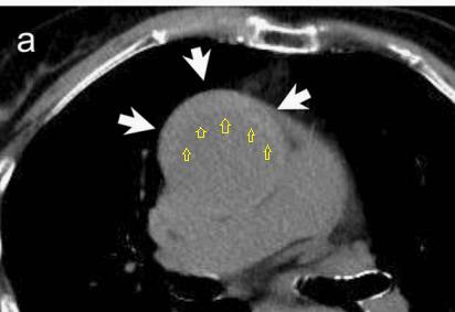 急性主动脉夹层的临床特征和影像学-13