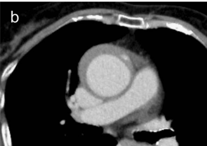 急性主动脉夹层的临床特征和影像学-14