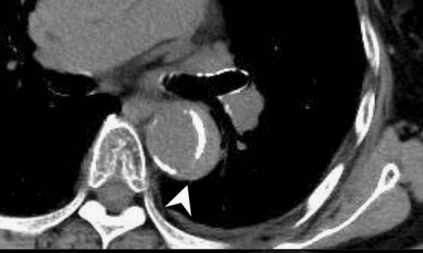 急性主动脉夹层的临床特征和影像学-15