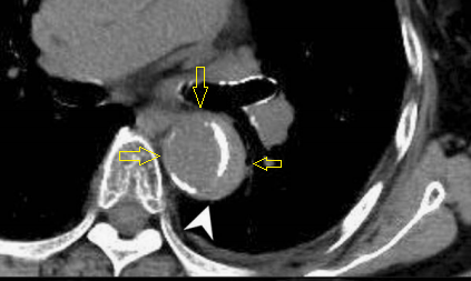 急性主动脉夹层的临床特征和影像学-16