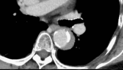 急性主动脉夹层的临床特征和影像学-17