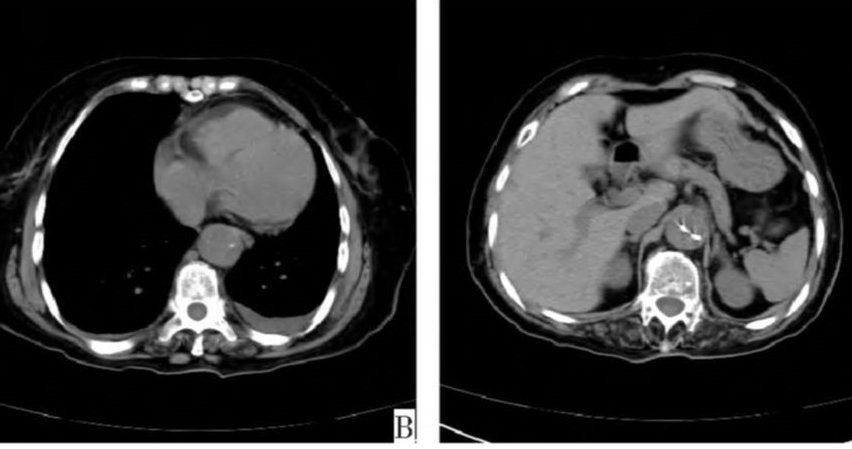 急性主动脉夹层的临床特征和影像学-18