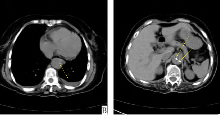 急性主动脉夹层的临床特征和影像学-19