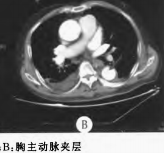 急性主动脉夹层的临床特征和影像学-21