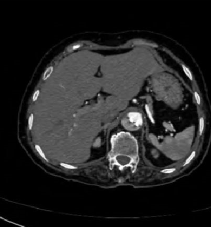 急性主动脉夹层的临床特征和影像学-20