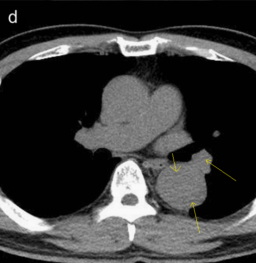 急性主动脉夹层的临床特征和影像学-23