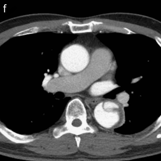 急性主动脉夹层的临床特征和影像学-24