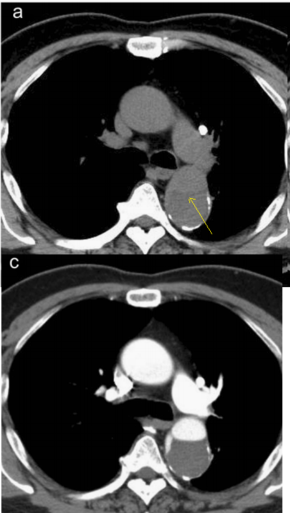 急性主动脉夹层的临床特征和影像学-25