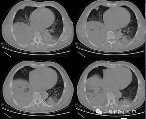 大叶性、小叶性、间质性肺炎你分清了吗？