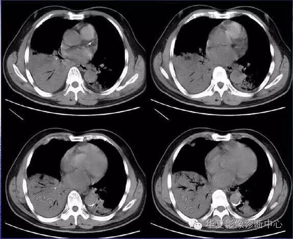 大叶性、小叶性、间质性肺炎你分清了吗？