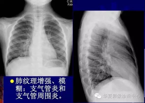 大叶性、小叶性、间质性肺炎你分清了吗？