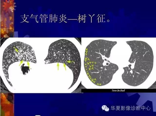 大叶性、小叶性、间质性肺炎你分清了吗？
