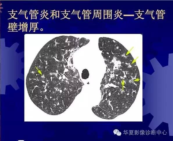 大叶性、小叶性、间质性肺炎你分清了吗？