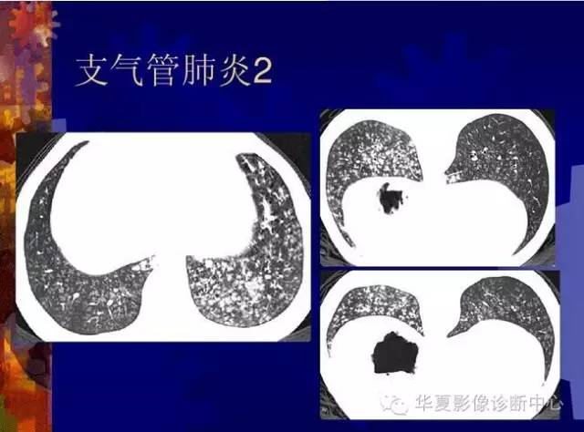 大叶性、小叶性、间质性肺炎你分清了吗？