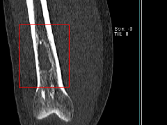 慢性骨髓炎1例X线CT及MR
