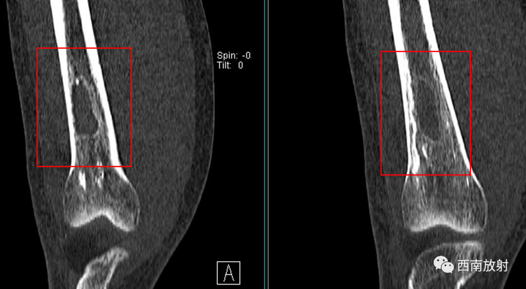 【病例】慢性骨髓炎1例X线CT及MR-4