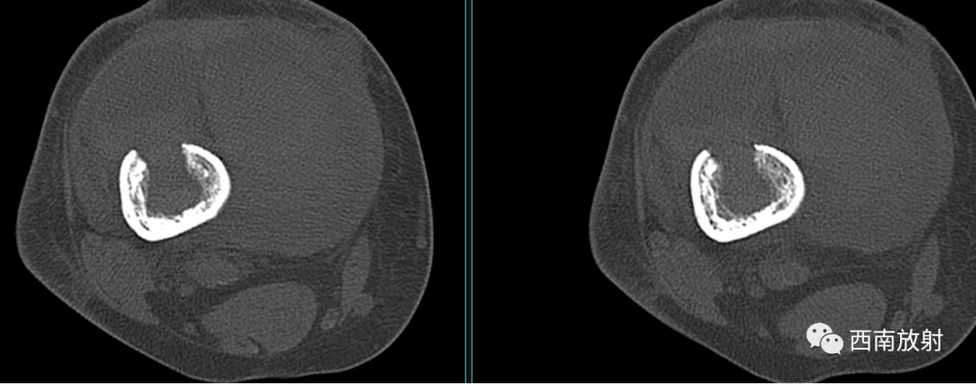 【病例】慢性骨髓炎1例X线CT及MR-3