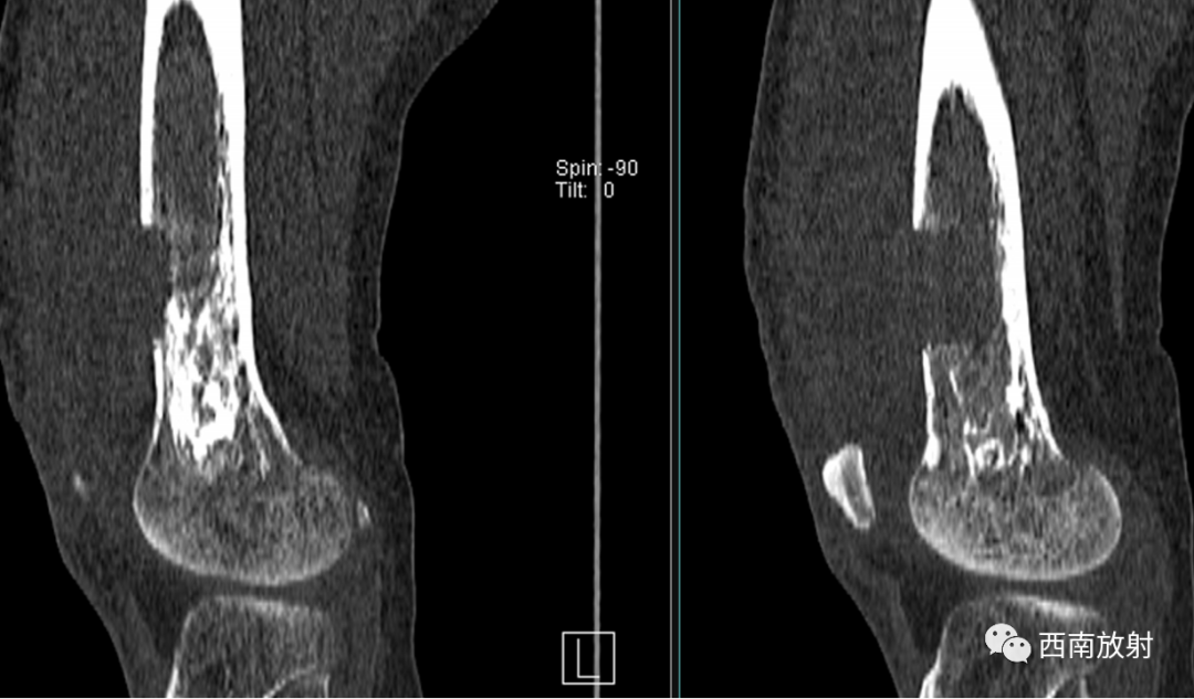 【病例】慢性骨髓炎1例X线CT及MR-5