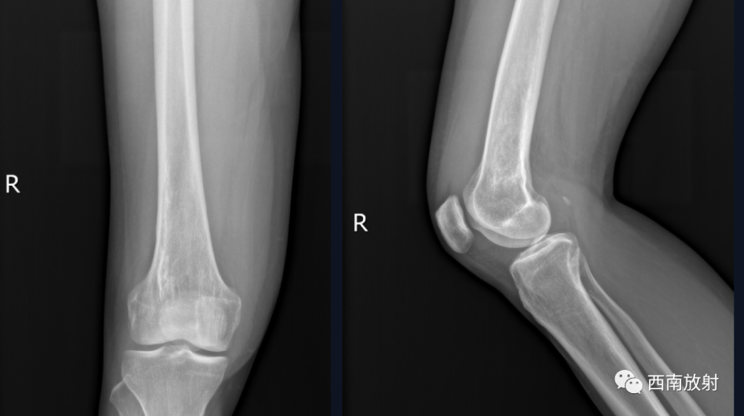 【病例】慢性骨髓炎1例X线CT及MR-2