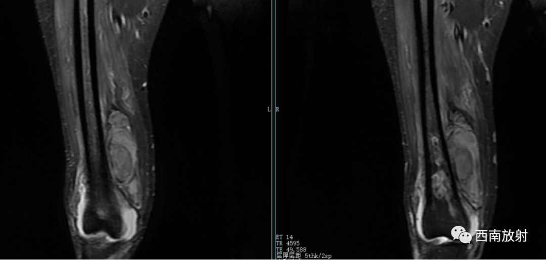【病例】慢性骨髓炎1例X线CT及MR-6