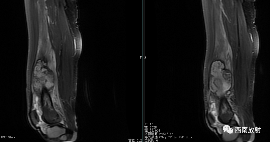 【病例】慢性骨髓炎1例X线CT及MR-8