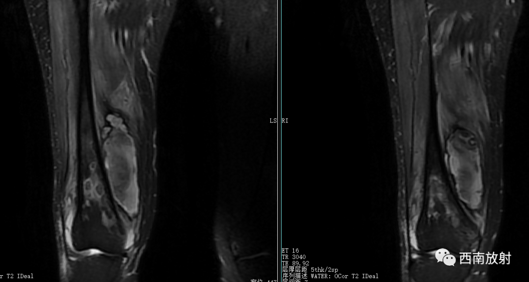【病例】慢性骨髓炎1例X线CT及MR-7