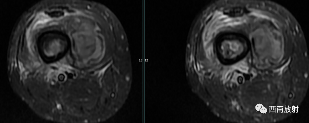 【病例】慢性骨髓炎1例X线CT及MR-9