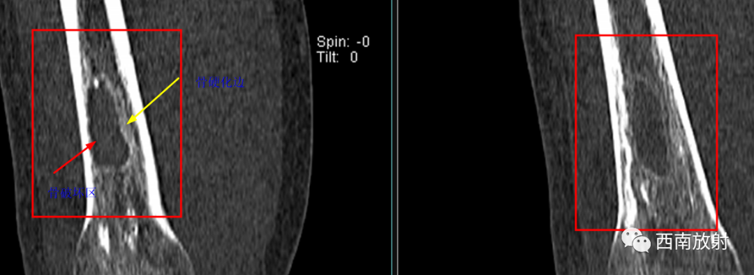 【病例】慢性骨髓炎1例X线CT及MR-12