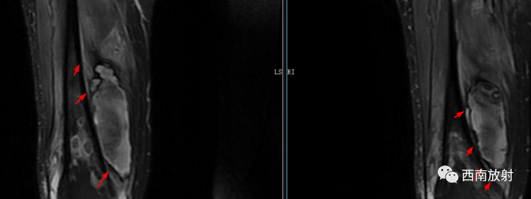 【病例】慢性骨髓炎1例X线CT及MR-13