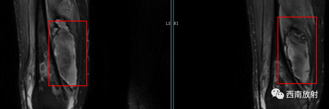 【病例】慢性骨髓炎1例X线CT及MR-14